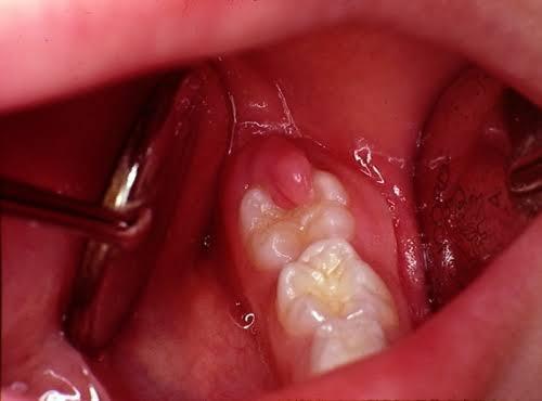 PERICORONITIS