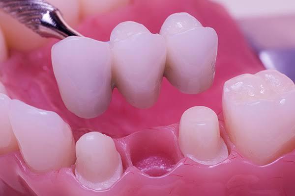 Teeth Replacement Options