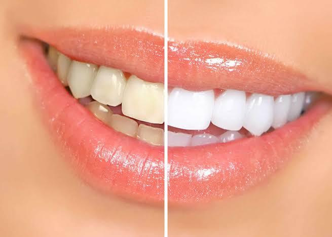 BRIGHTER TEETH