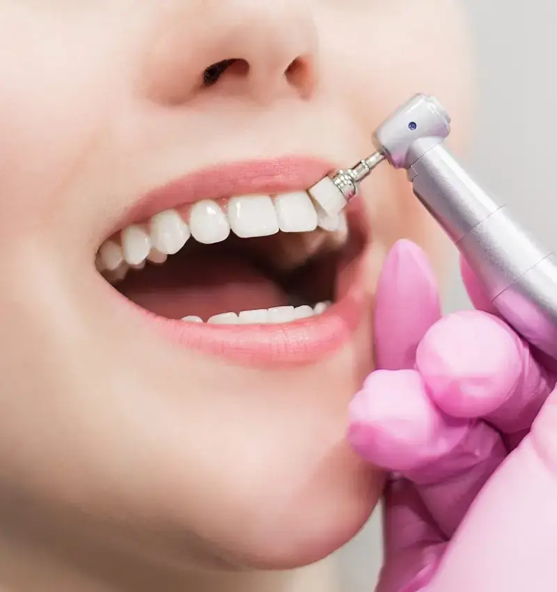 Professional Teeth Cleaning in Abuja: Why Scaling & Polishing is Essential for Healthy Smiles | Aster Smiles Dental Clinic Guzape