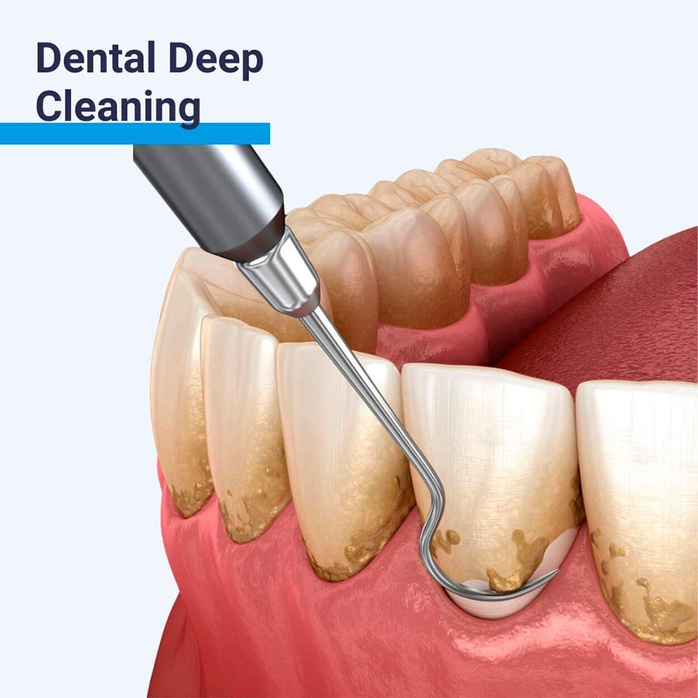 Dental Deep Cleaning (Scaling & Root Planing) in Abuja