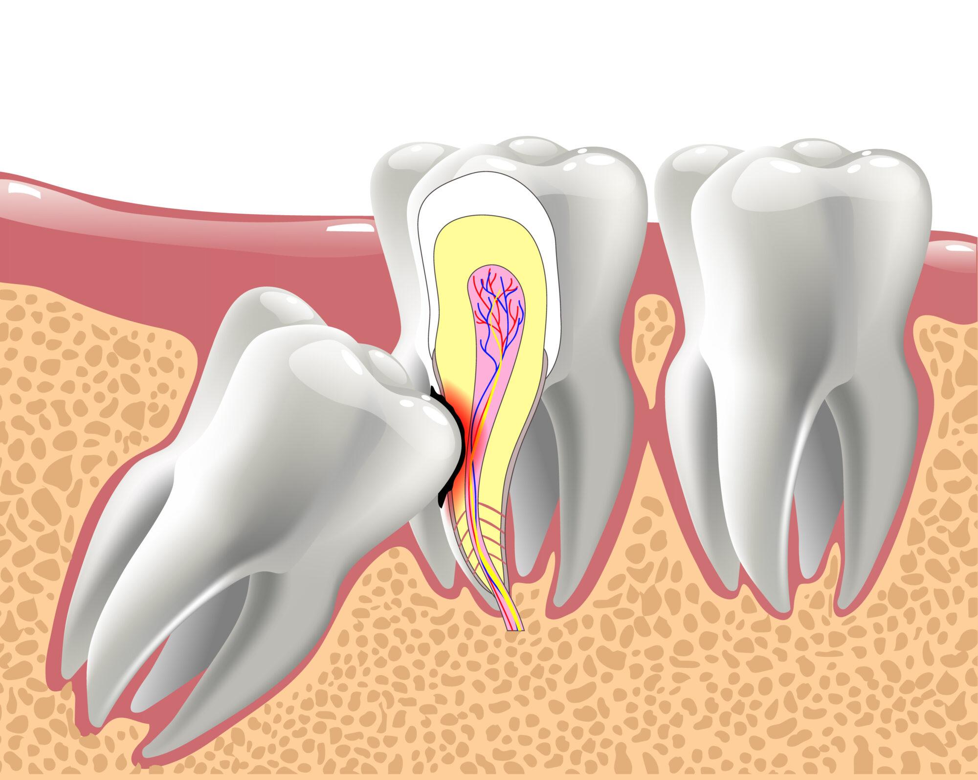 Dangers of Impacted Wisdom Teeth & Expert Treatment Options in Abuja | Aster Smiles
